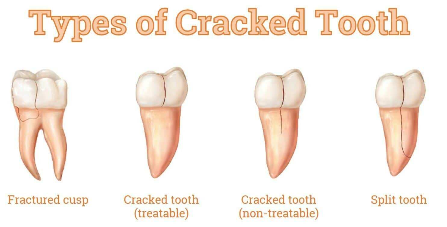 Management of cracked tooth