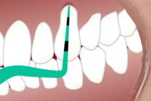 periodental treatments