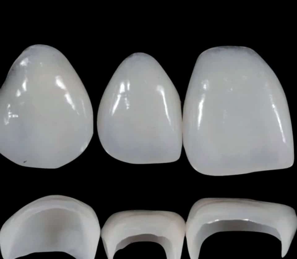 Tooth colored restorations