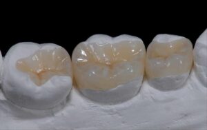 Tooth colored restorations